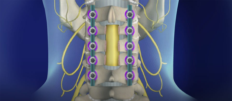 Laminectomy Cervical With Fusion Haider Spine Center 