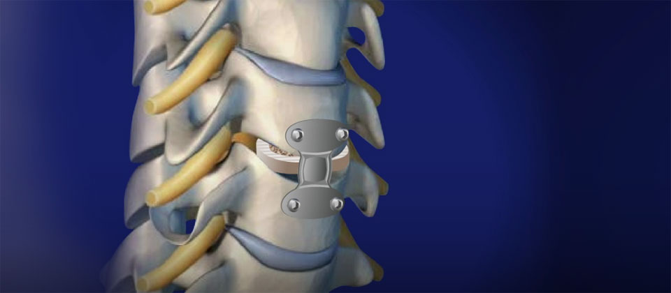ACDF: Intervertebral Spacer | Haider Spine Center